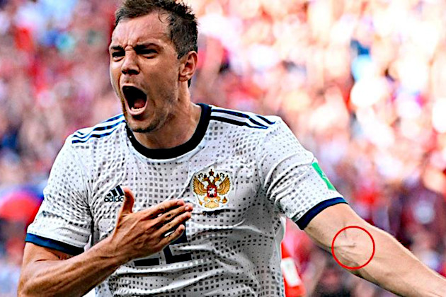 Артём Дзюба со следом от укола